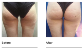 cellulite reduction treatment